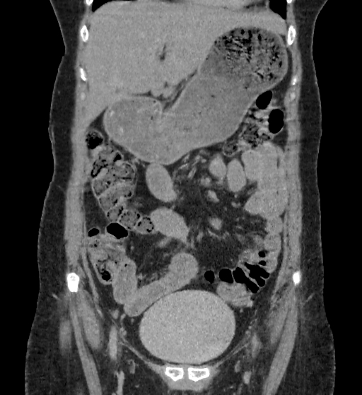 Autosomal dominant polycystic kidney disease (Radiopaedia 38189-40194 Coronal C+ delayed 17).jpg