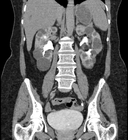 Autosomal dominant polycystic kidney disease (Radiopaedia 38189-40194 Coronal C+ delayed 54).jpg