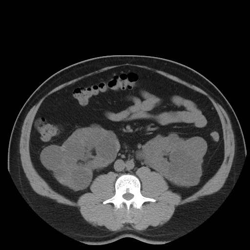 Autosomal dominant polycystic kidney disease (Radiopaedia 50259-55612 Axial non-contrast 45).jpg