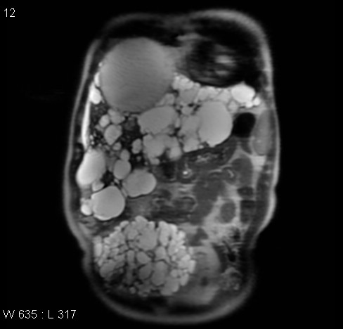 File:Autosomal dominant polycystic kidney disease (Radiopaedia 5202-6969 Coronal T2 3).jpg