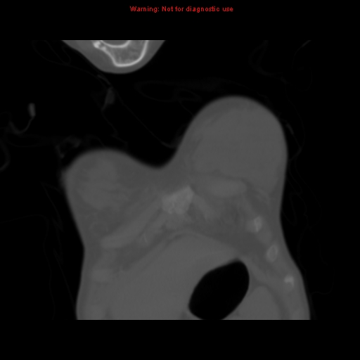 Avascular necrosis in sickle cell disease (Radiopaedia 17448-17152 Coronal bone window 9).jpg