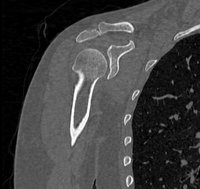 Avulsion fracture - greater tuberosity of humerus (Radiopaedia 71216-81514 Coronal bone window 29).jpg