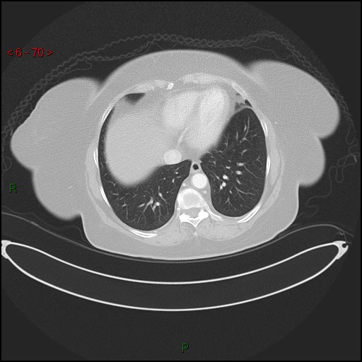 File:Azygos fissure and lobe (Radiopaedia 47620-52278 Axial lung window 70).jpg