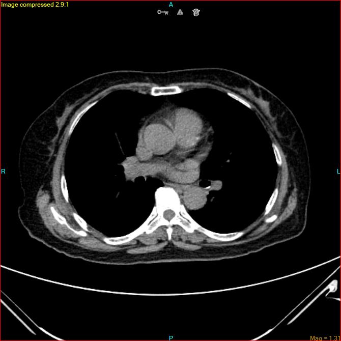 Azygos vein aneurysm (Radiopaedia 77824-90130 A 31).jpg