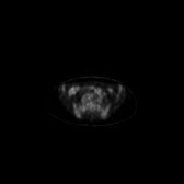 B-cell lymphoma of the mesentery (Radiopaedia 65743-74868 18F-FDG PET-CT 101).jpg