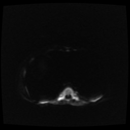 B cell lymphoma (Radiopaedia 56281-62954 Axial DWI 3).jpg