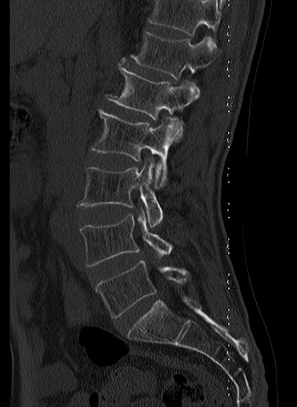 File:Baastrup syndrome (Radiopaedia 64891-73838 Sagittal bone window 6).jpg