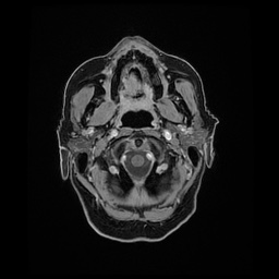 Balo concentric sclerosis (Radiopaedia 53875-59982 Axial LAVA C+ 21).jpg