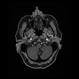 Balo concentric sclerosis (Radiopaedia 53875-59982 Axial LAVA C+ 35).jpg