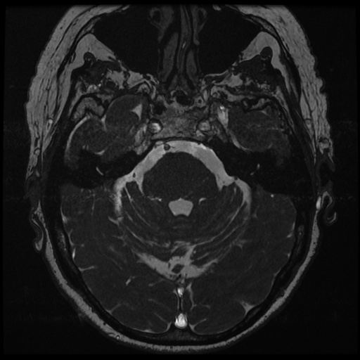 File:Balo concentric sclerosis (Radiopaedia 53875-59982 Axial T2 FIESTA 50).jpg