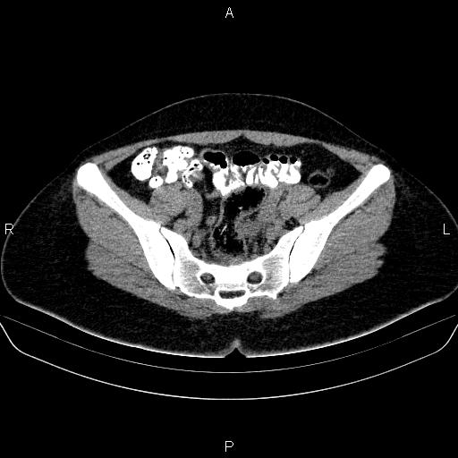 File:Bartholin gland cyst (Radiopaedia 62635-70930 Axial non-contrast 31).jpg