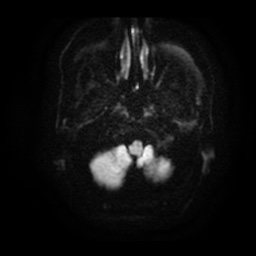 File:Basal cell carcinoma (periorbital) (Radiopaedia 55179-61559 Axial DWI 3).jpg