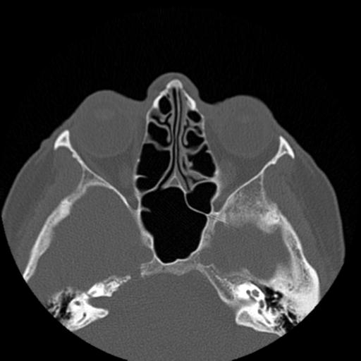 File:Base of skull chondrosarcoma (Radiopaedia 30410-31071 Axial bone window 24).jpg