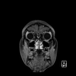 File:Base of skull rhabdomyosarcoma (Radiopaedia 32196-33142 I 18).jpg