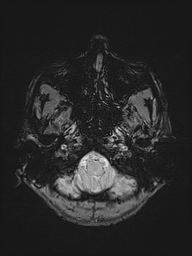File:Basilar artery perforator aneurysm (Radiopaedia 82455-97733 Axial SWI 3).jpg