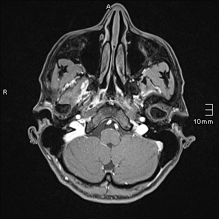 Basilar artery perforator aneurysm (Radiopaedia 82455-99523 G 11).jpg