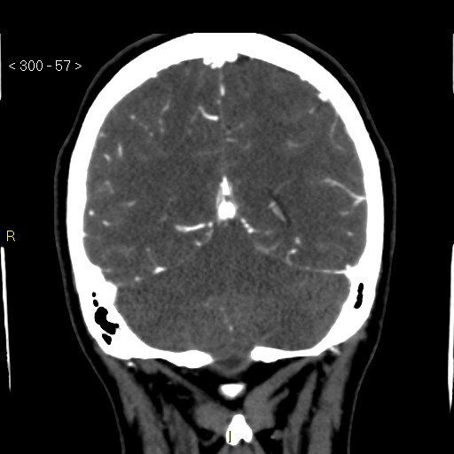 File:Basilar artery thrombosis (Radiopaedia 16260-15944 B 48).jpg