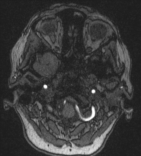 Basilar tip aneurysm (Radiopaedia 26504-26632 MRA 22).jpg