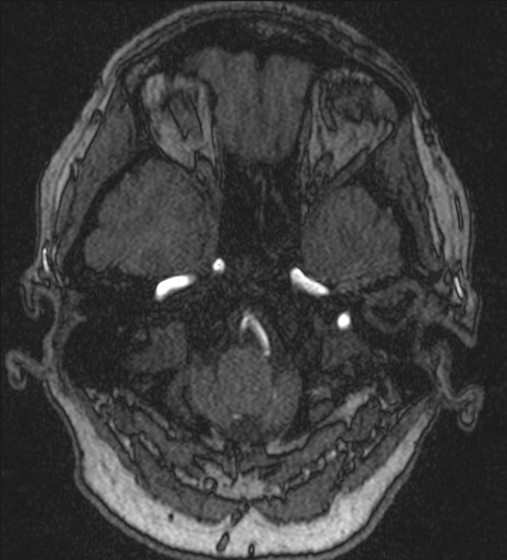 Basilar tip aneurysm (Radiopaedia 26504-26632 MRA 35).jpg