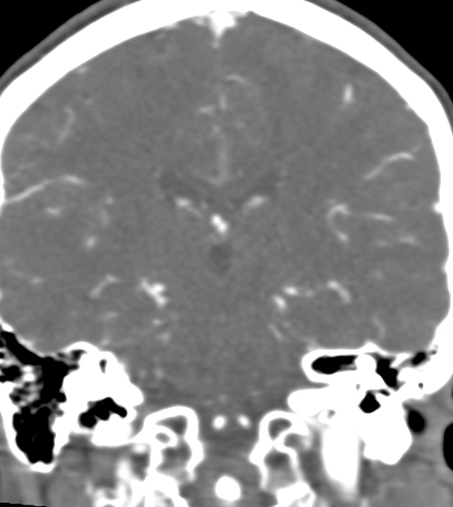 Basilar tip aneurysm with coiling (Radiopaedia 53912-60086 B 90).jpg
