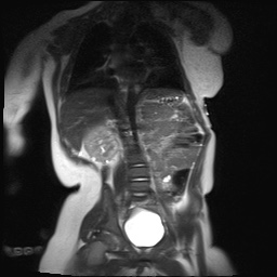 File:Beckwith-Wiedeman syndrome with bilateral Wilms tumors (Radiopaedia 60850-69233 B 12).jpg