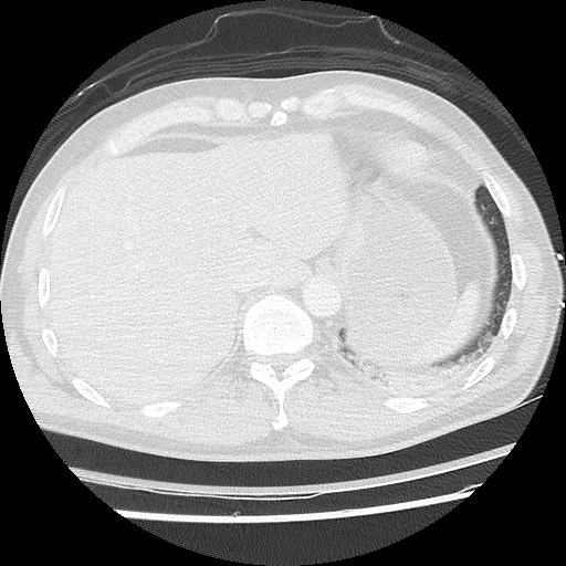 File:Benign post-traumatic pseudopneumoperitoneum (Radiopaedia 71199-81495 Axial lung window 62).jpg