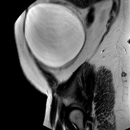 File:Benign seromucinous cystadenoma of the ovary (Radiopaedia 71065-81300 Sagittal T2 23).jpg