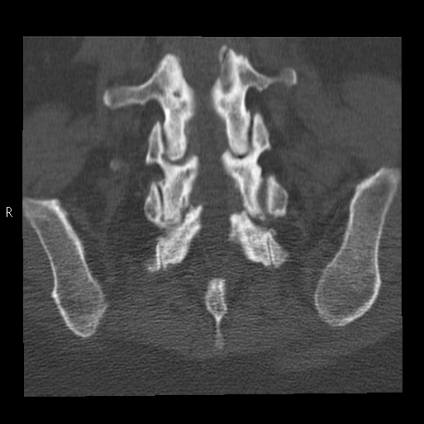 Bertolotti syndrome (Radiopaedia 24864-25128 Coronal bone window 37).jpg