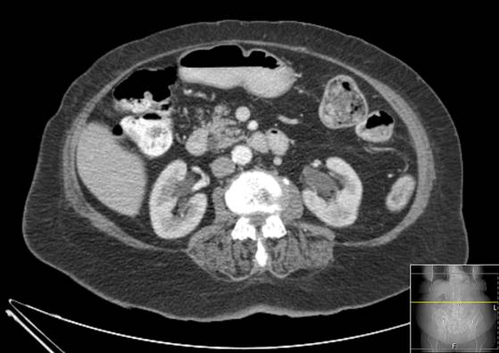 Bicameral celiacomesenteric aneurysm (Radiopaedia 55766-62327 A 28).jpg