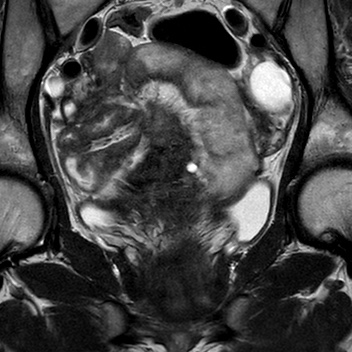 File:Bicornuate uterus (Radiopaedia 61974-70046 Coronal T2 10).jpg