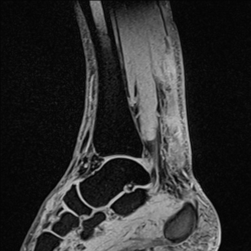 File:Bilateral Achilles tendon complete tear (Radiopaedia 81344-95051 Sagittal WE - Right 65).jpg