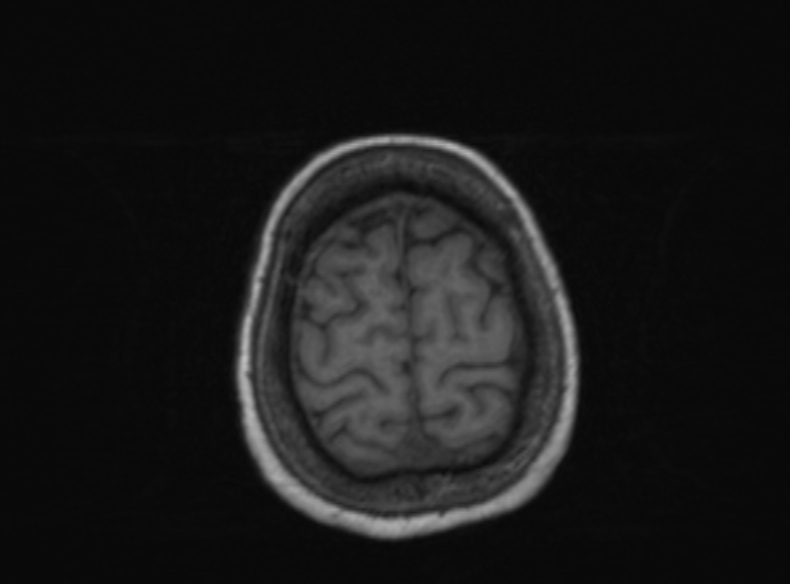Bilateral PCA territory infarction - different ages (Radiopaedia 46200-51784 Axial T1 140).jpg