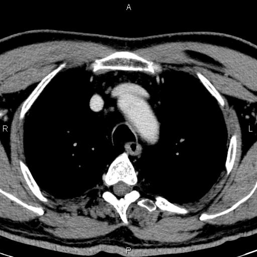Bilateral Warthin tumors (Radiopaedia 84034-99263 Axial With contrast 75).jpg
