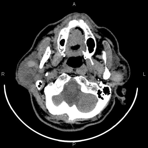 Bilateral Warthin tumors (Radiopaedia 84034-99263 Axial non-contrast 13).jpg