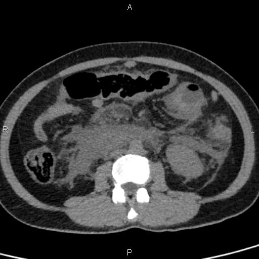 File:Bilateral adrenal gland hyperenhancement in pancreatitis (Radiopaedia 86642-102753 Axial non-contrast 60).jpg