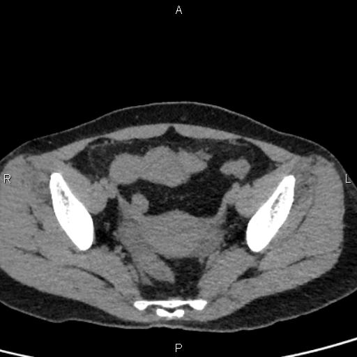 Bilateral adrenal gland hyperenhancement in pancreatitis (Radiopaedia 86642-102753 Axial non-contrast 95).jpg