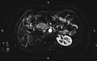 Bilateral adrenal myelolipoma (Radiopaedia 63058-71537 I 43).jpg