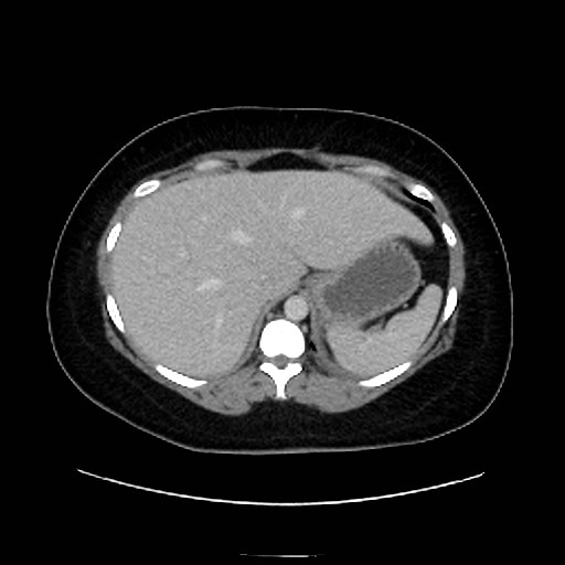 Bilateral adrenal thrombosis (Radiopaedia 58182-65256 A 11).jpg