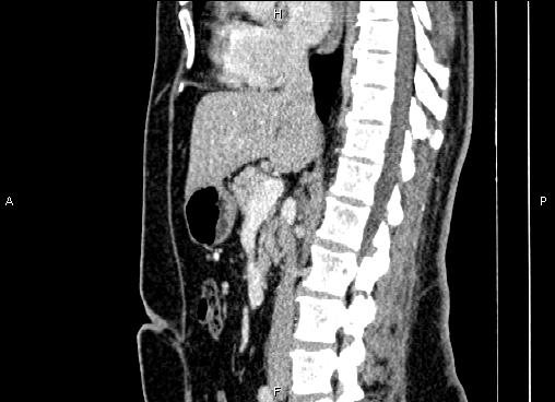 Bilateral benign adrenal adenomas (Radiopaedia 86912-103124 E 48).jpg
