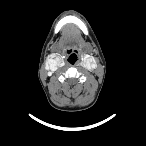 Bilateral carotid body tumors (Radiopaedia 52899-58827 A 10).jpg