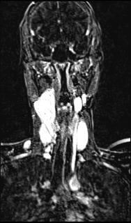 Bilateral carotid body tumors and right glomus jugulare tumor (Radiopaedia 20024-20060 MRA 94).jpg