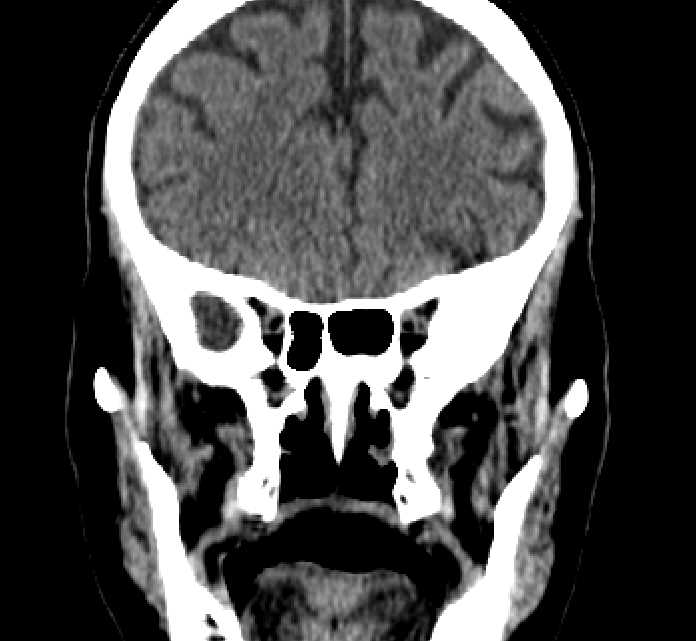 Bilateral ectopia lentis (Radiopaedia 89889-107013 Coronal non-contrast 99).jpg