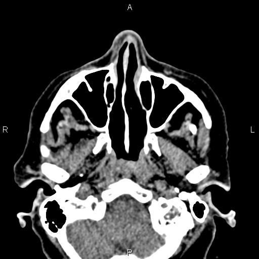 Bilateral enlargement of lacrimal glands - sarcoidosis (Radiopaedia 62627-70921 Axial non-contrast 13).jpg
