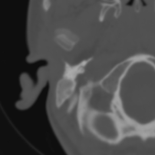 Bilateral otosclerosis (Radiopaedia 57237-64157 B 14).jpg