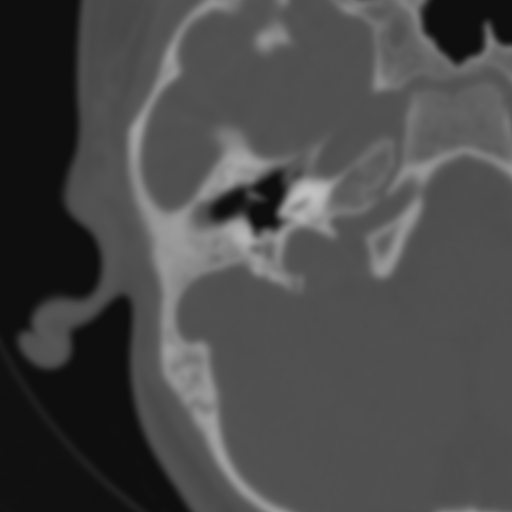 File:Bilateral otosclerosis (Radiopaedia 57237-64157 B 49).jpg
