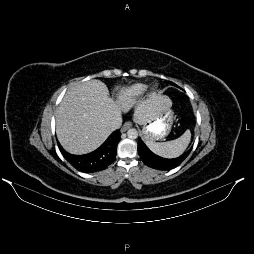 Bilateral ovarian dermoid cysts (Radiopaedia 85785-101603 A 15).jpg