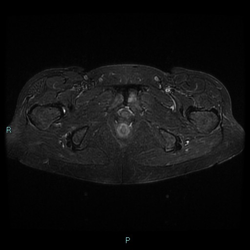 File:Bilateral ovarian fibroma (Radiopaedia 44568-48293 Axial STIR 27).jpg