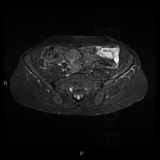 File:Bilateral ovarian fibroma (Radiopaedia 44568-48293 Axial STIR 5).jpg