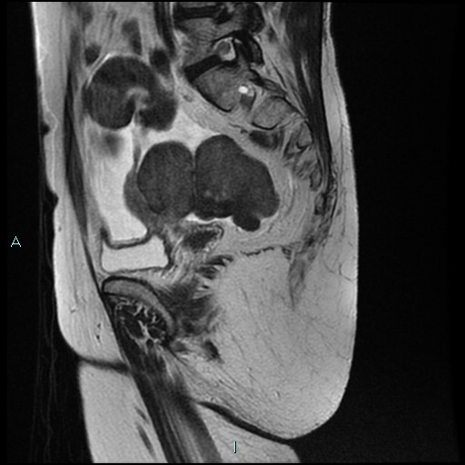 File:Bilateral ovarian fibroma (Radiopaedia 44568-48293 Sagittal T2 22).jpg