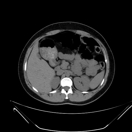 File:Bilateral ovarian mature cystic teratomas (Radiopaedia 79373-92457 Axial non-contrast 10).jpg